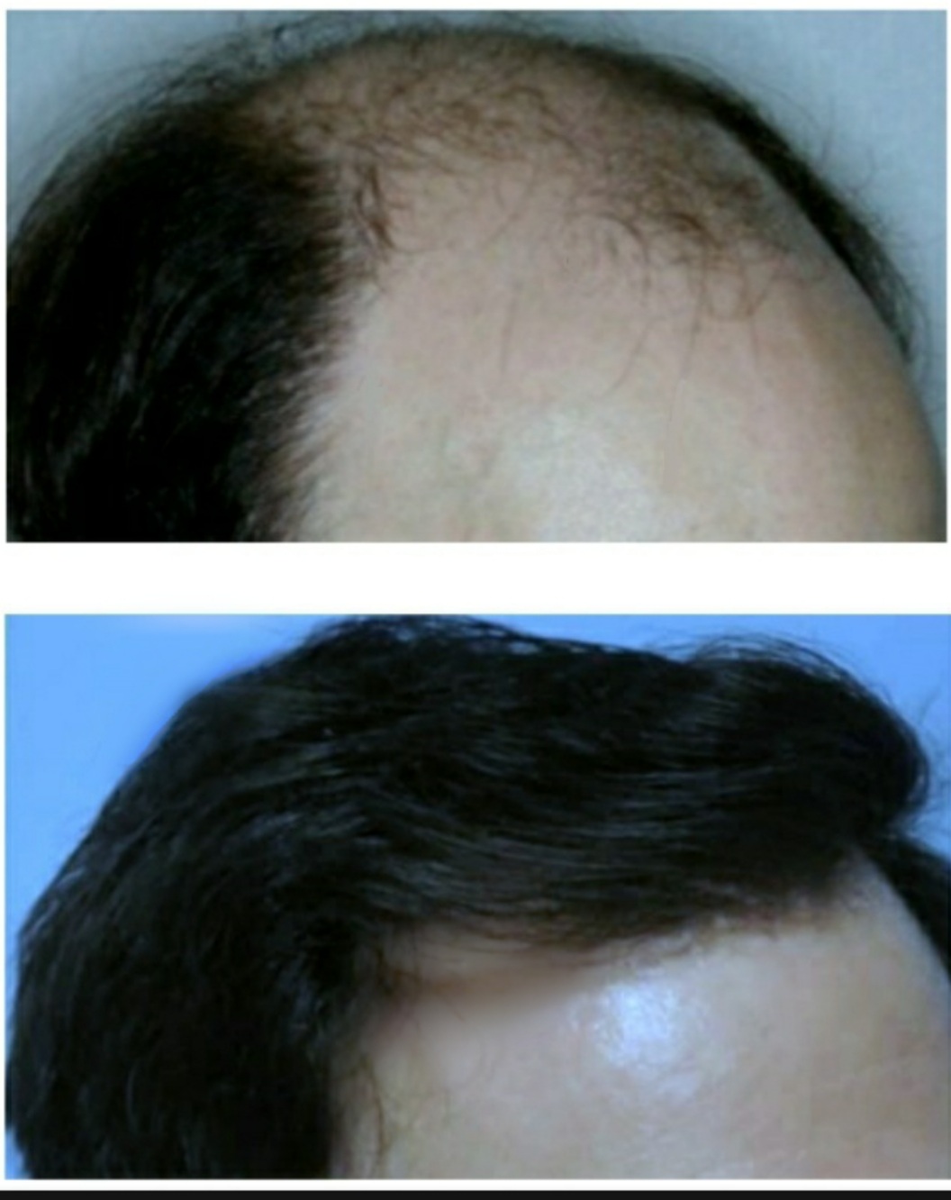 Alopecia Androgénica masculina