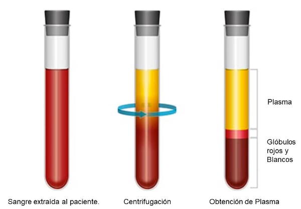 Plasma rico en plaquetas PRP