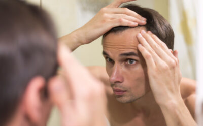 La Escala Hamilton-Norwood para medir la alopecia en hombres
