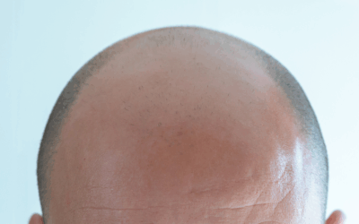 Curiosidades sobre la alopecia