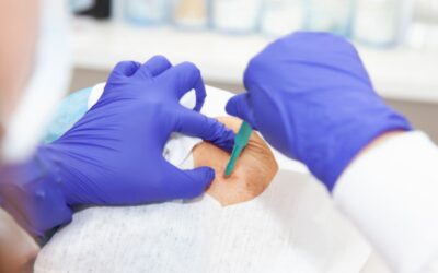 Biopsia capilar: el primer paso para un tratamiento personalizado contra la alopecia