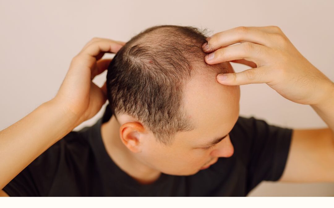 Signos de alopecia temprana: cómo detectarla a tiempo y actuar antes de que avance