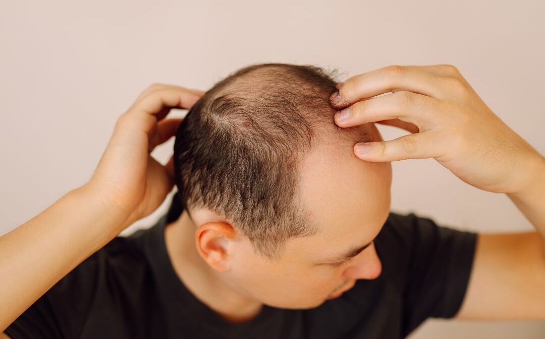 Signos de alopecia temprana