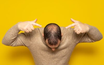 Mitos y verdades sobre la alopecia que probablemente no conocías