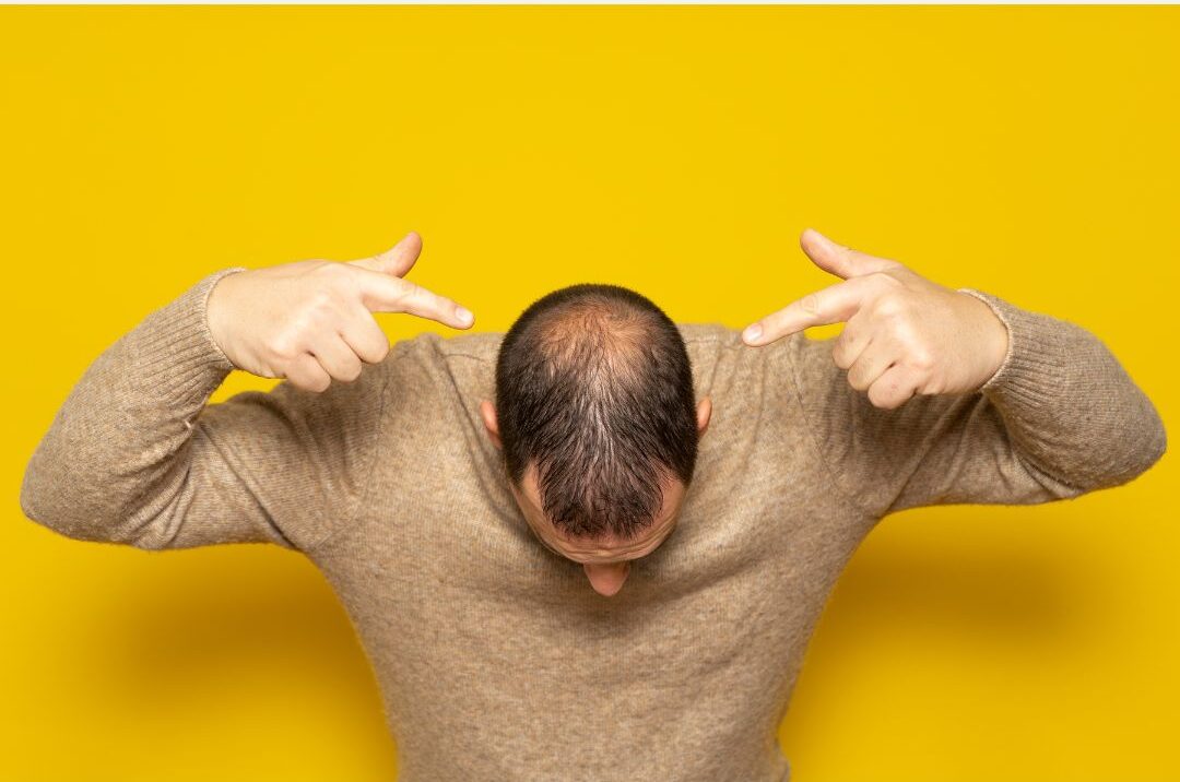 Mitos y verdades sobre la alopecia