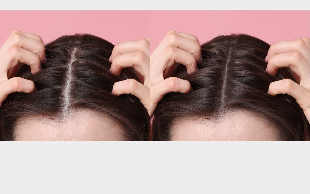 Diferencias entre alopecia femenina y masculina