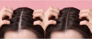 Diferencias entre alopecia femenina y masculina