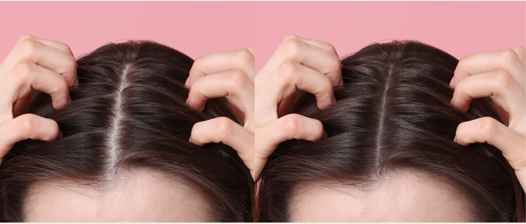 Diferencias entre alopecia femenina y masculina