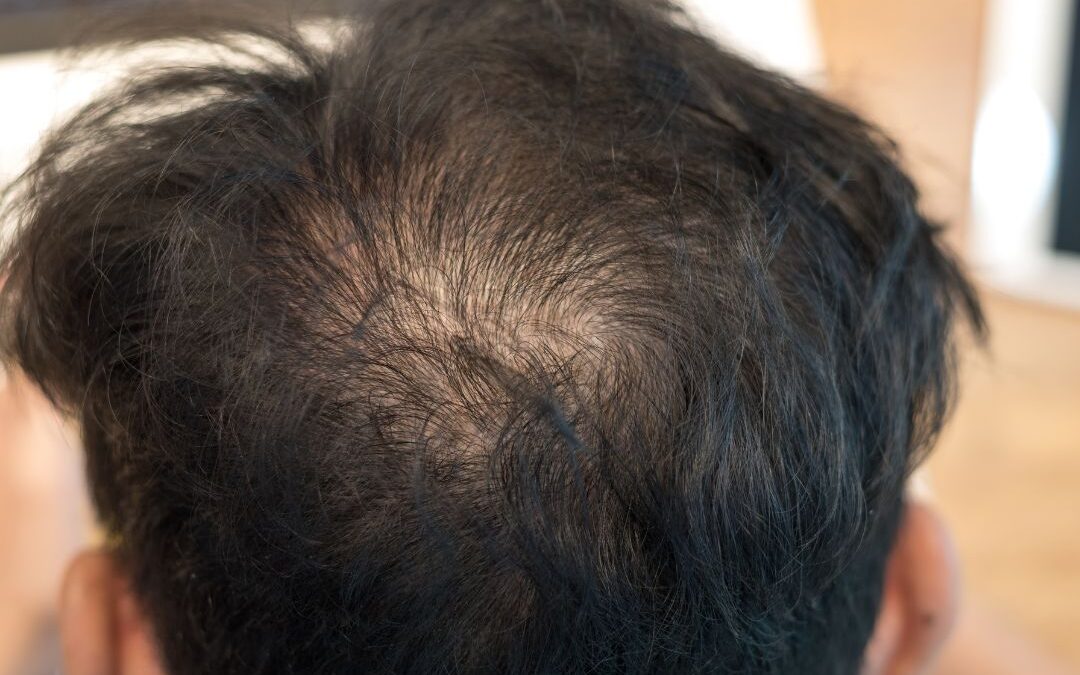 ¿Qué es la DHT y qué relación tiene con la alopecia?