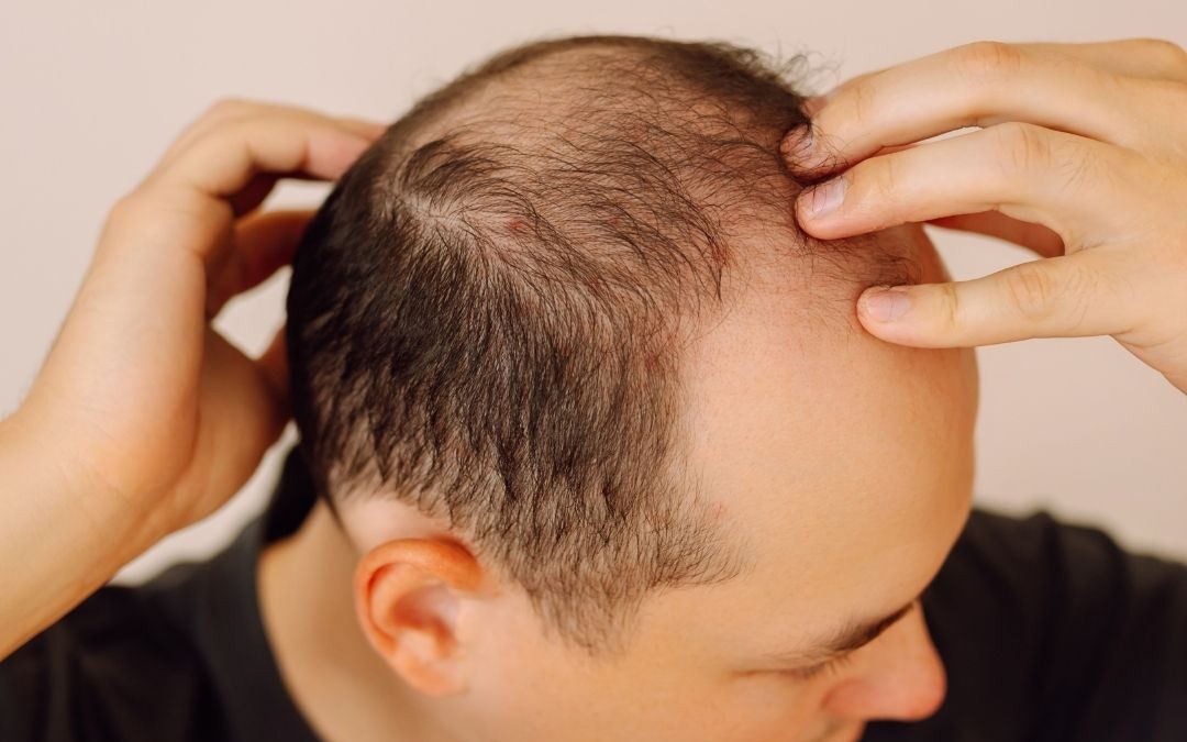 ¿El minoxidil funciona para todo el mundo?