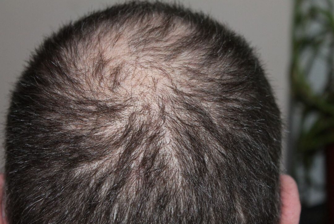 controlar la alopecia